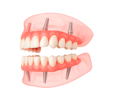 Имплантация зубов